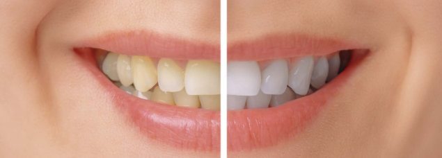 Teeth Whitening Ville Saint-Laurent